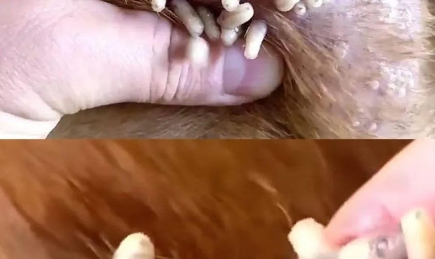 Giant acne – Blackhead Acne Removal